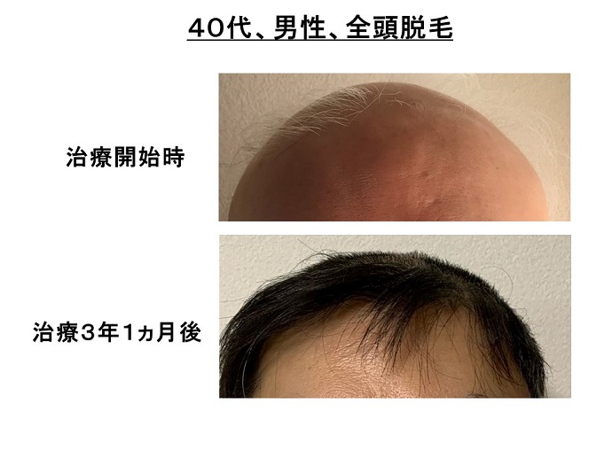 円形脱毛症　病院